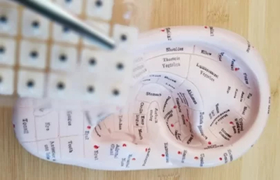 Auricular acupuncture